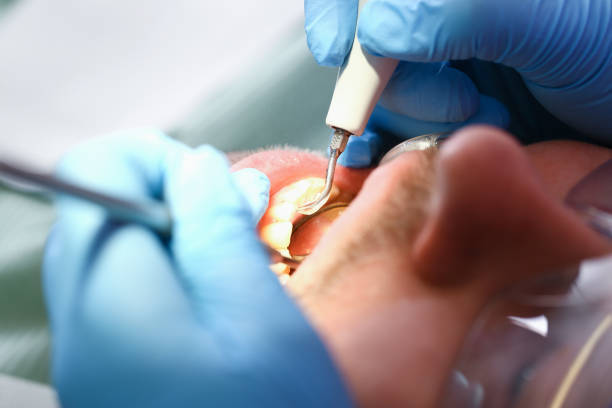Best Dentist for Tooth Abscess  in Sweetwater, TX